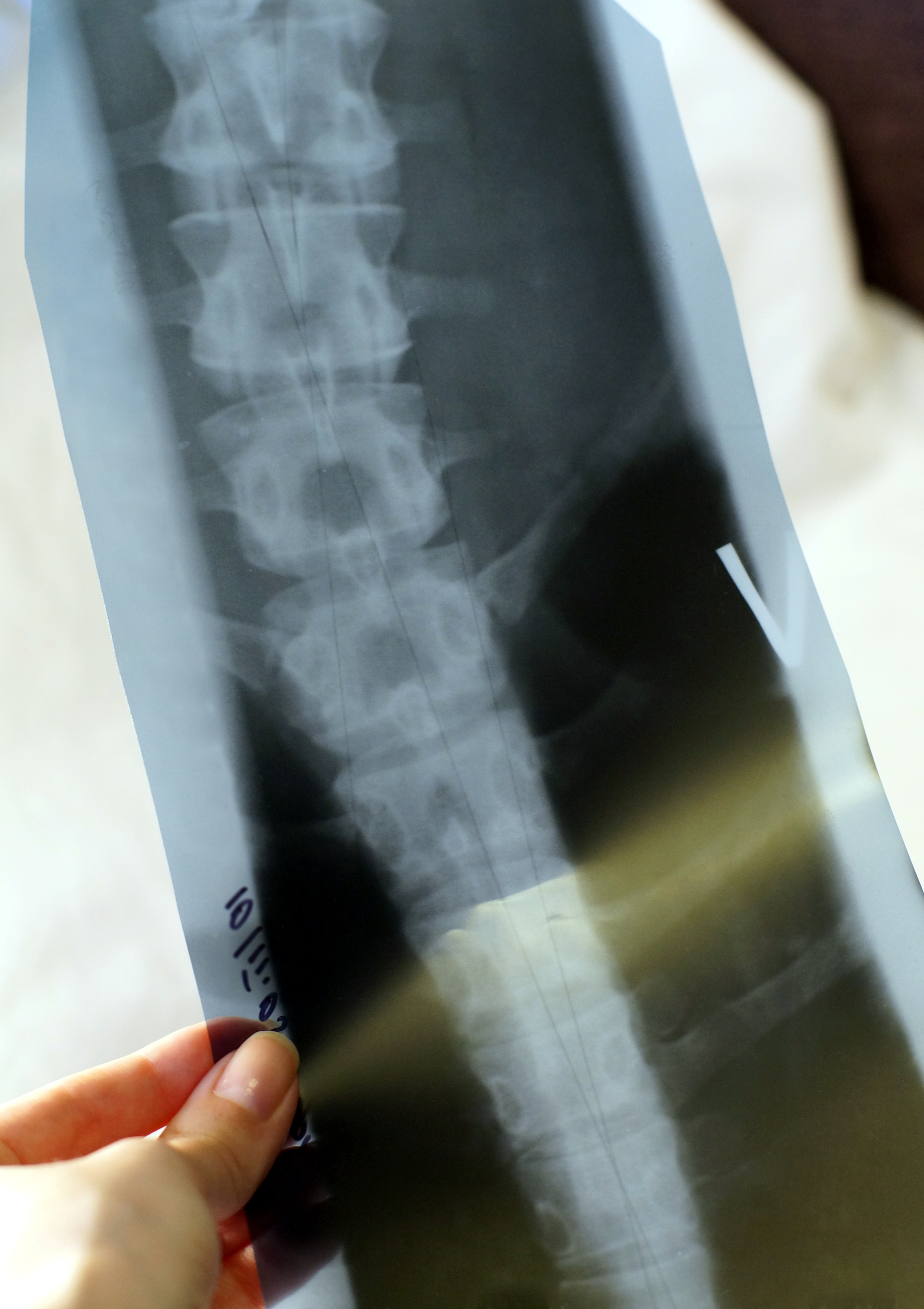 Picture of spine X-ray